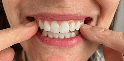 Patient 1 after treatment