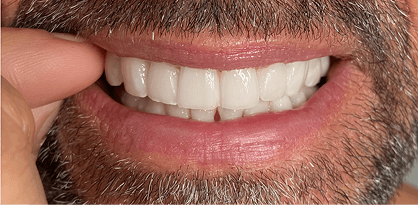 Patient 3 after treatment