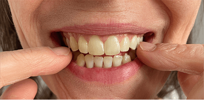 Patient 1 before treatment