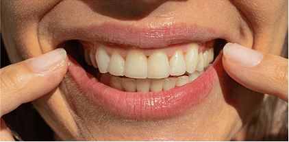 Patient 2 before treatment