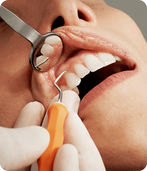 Dental cleaning procedure close-up