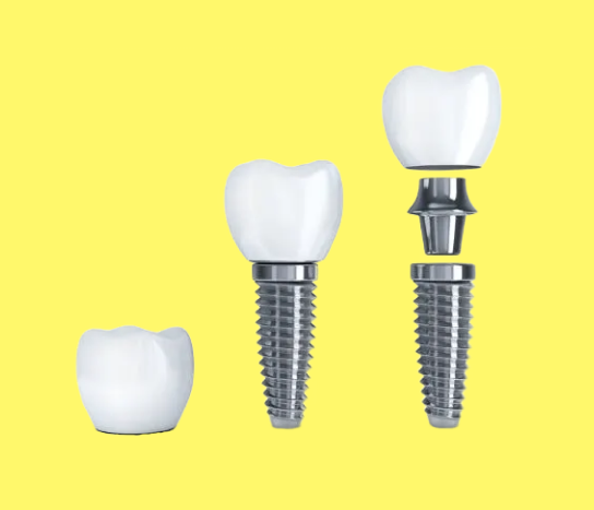 Dental implant crown, abutment, and titanium post