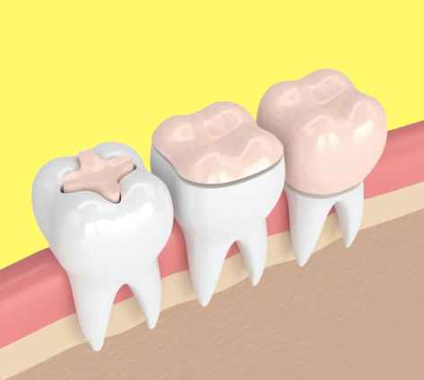 Illustration of fillings and crowns on teeth