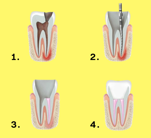 Root canal procedure steps diagram